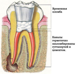 Современное пломбирование каналов зуба